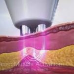 MAXIMUS REVIVE TRILIPO LUMENIS.