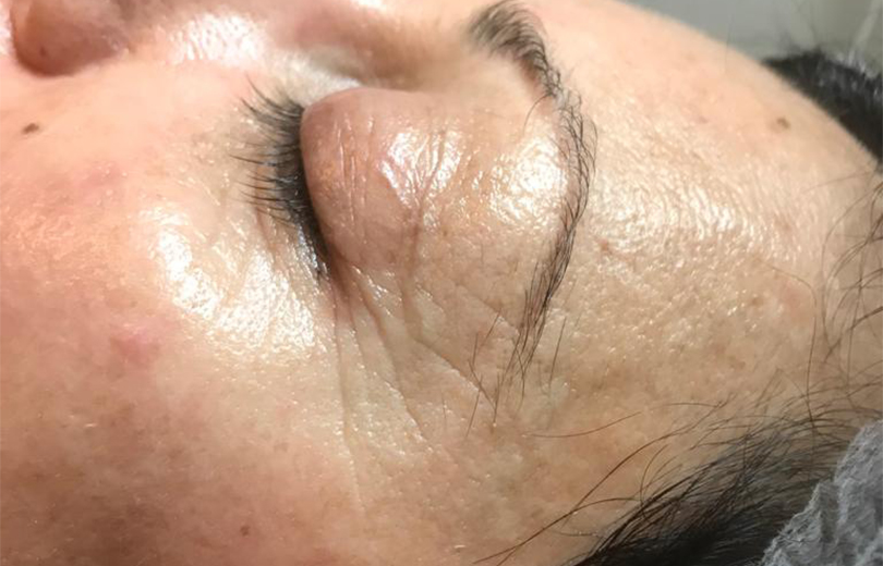 tramento viso anti aging dopo